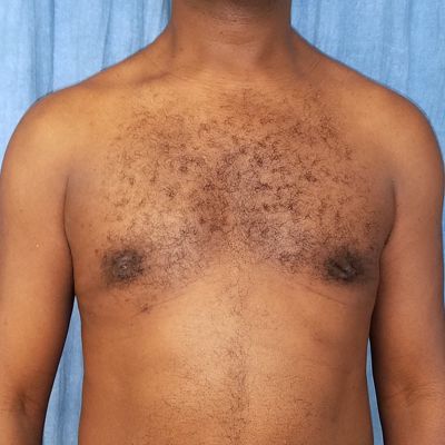 Male Breast Reduction Before and After Patient 6