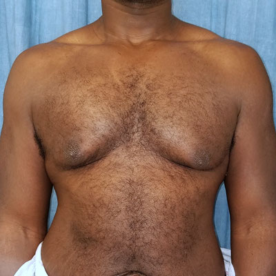 Male Breast Reduction Before Photo
