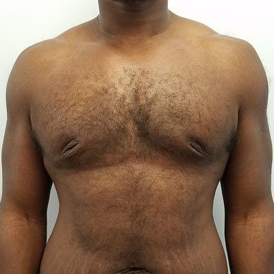 Male Breast Reduction Before and After Patient 7