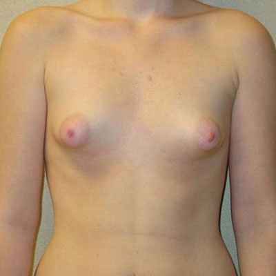 Tuberous Breasts Before Photo