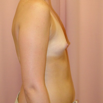 Tuberous Breast Surgery Before & After Image
