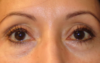 Lower Blepharoplasty Before and After patient 1