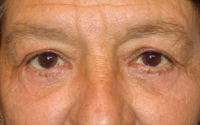 Lower Blepharoplasty Before and After patient 2