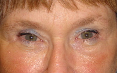 Upper Blepharoplasty Before and After patient 4