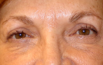 Upper Blepharoplasty Before and After patient 6
