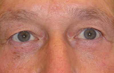 Lower Blepharoplasty Before and After patient 8