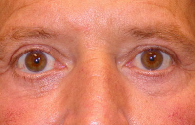 Lower Blepharoplasty Before and After patient 10