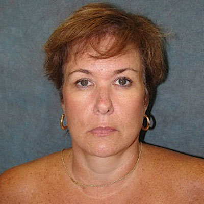 Facelift Before and After patient 2