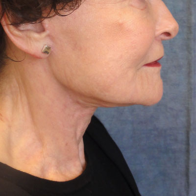 Neck Lift Before and After patient 1