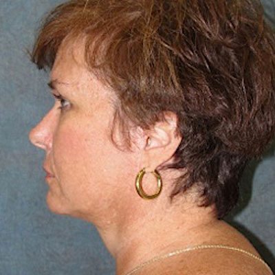 Neck Liposuction Before and After patient 2